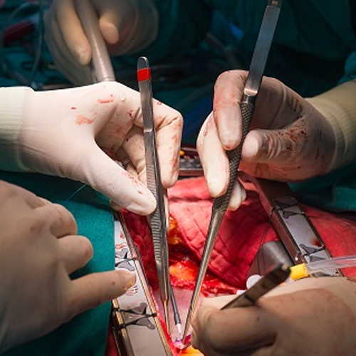 cabg